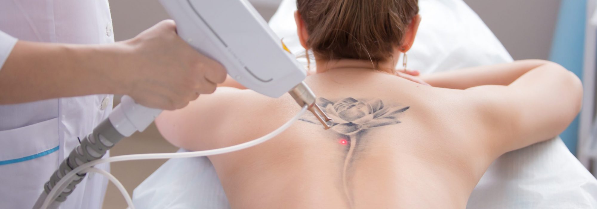laser tattoo removal from back